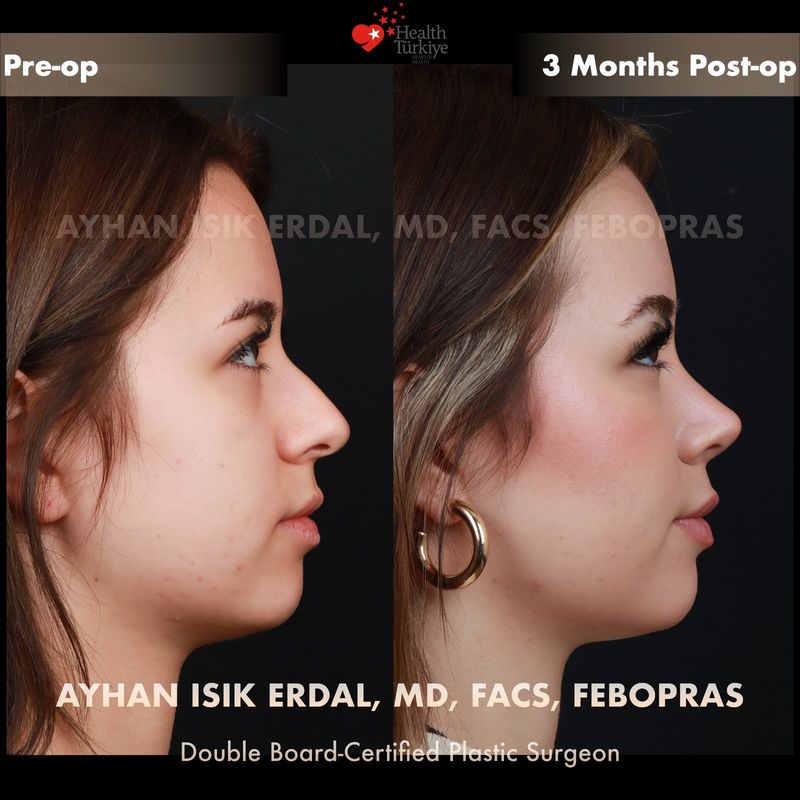 Rhinoplasty Turkey before and after — female patient profile view, 3 months post-op