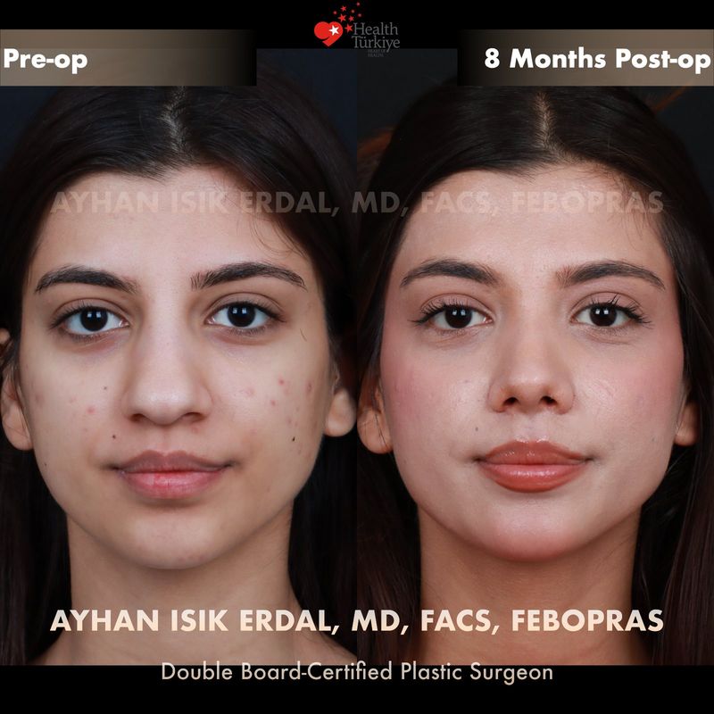 Closed rhinoplasty results — female patient frontal view, 8 months post-op