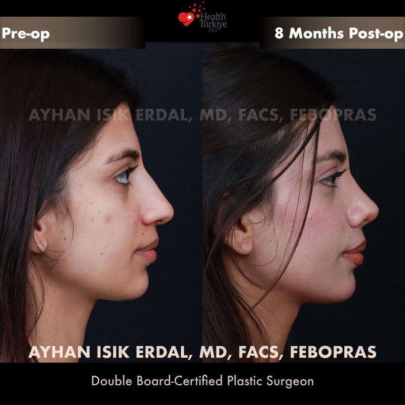 Closed rhinoplasty results — female patient oblique view, 8 months post-op