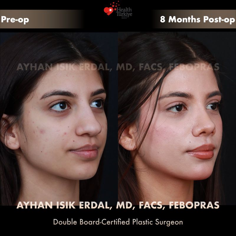 Closed rhinoplasty results — female patient profile view, 8 months post-op