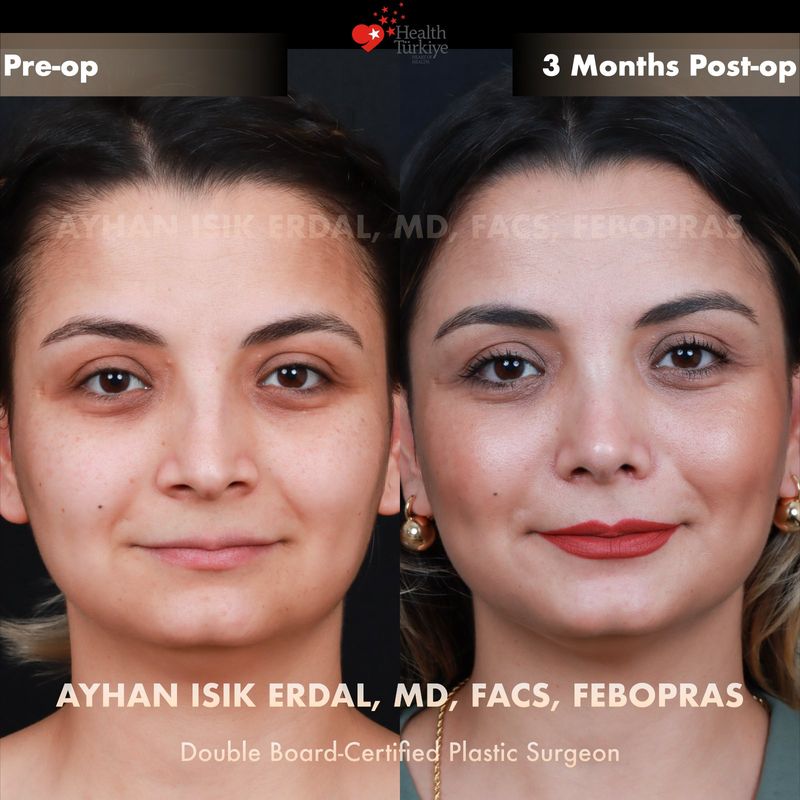 Nose surgery Turkey results — female patient frontal view