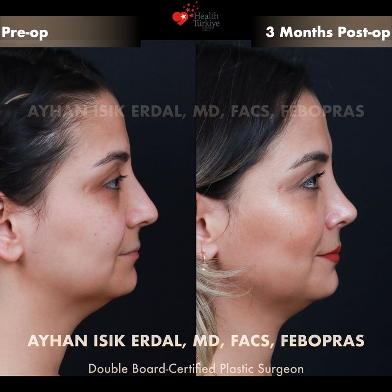 Nose surgery Turkey results — female patient oblique view
