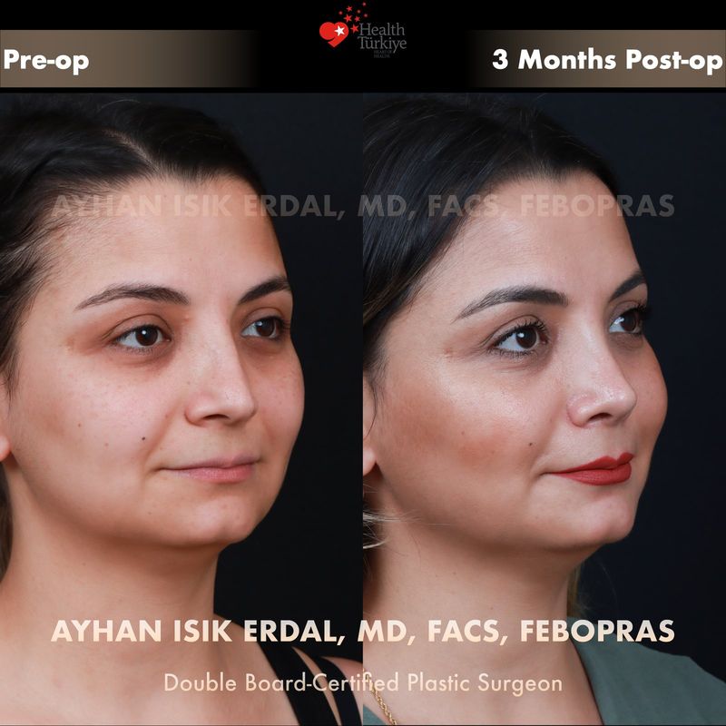 Nose surgery Turkey results — female patient profile view