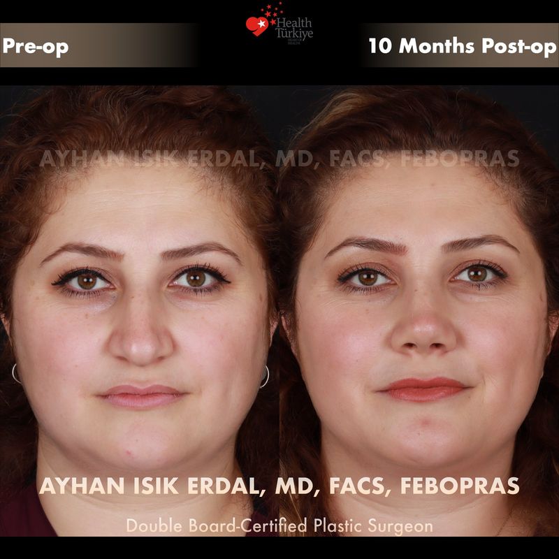 Closed technique rhinoplasty result — female patient frontal view