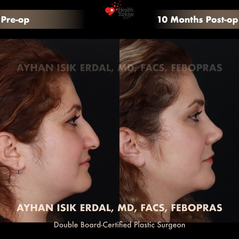 Closed technique rhinoplasty result — female patient profile view