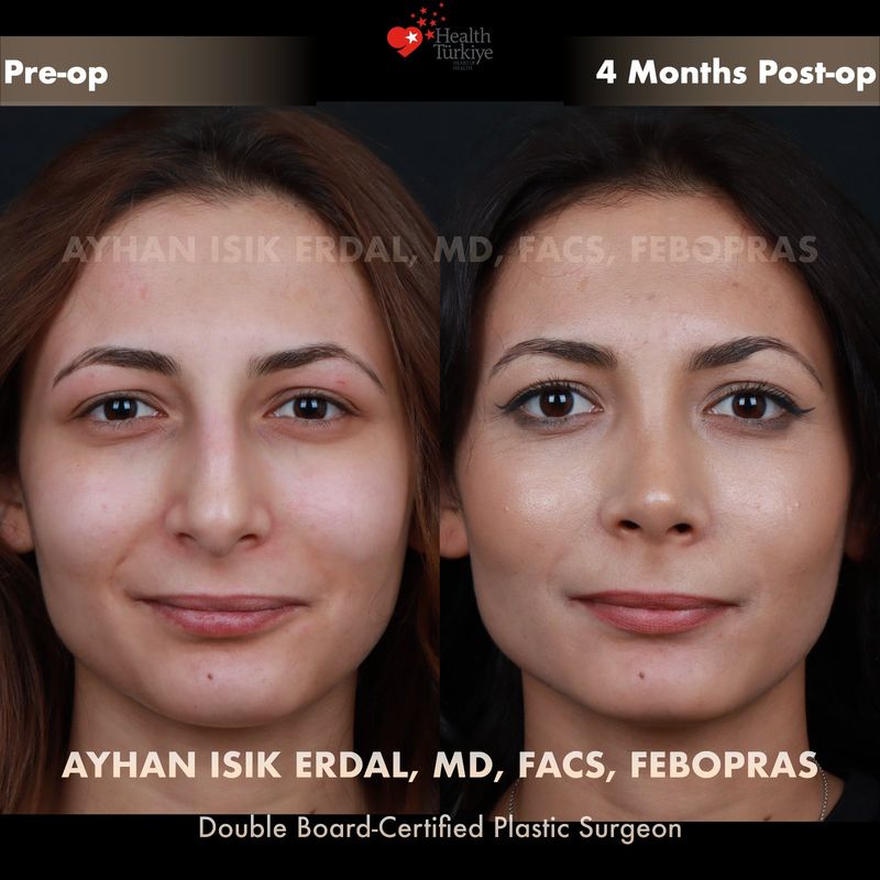 Closed rhinoplasty before and after — female patient frontal view, 4 months post-op