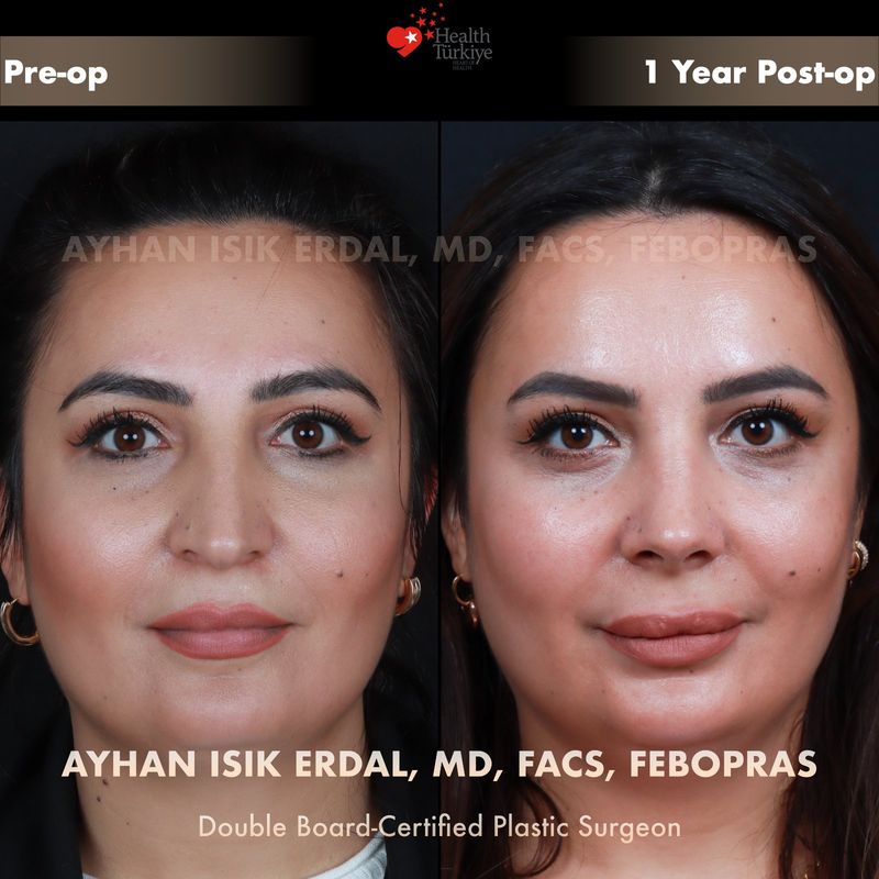 No scar rhinoplasty before and after — female patient frontal view
