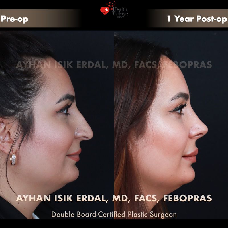 No scar rhinoplasty before and after — female patient profile view