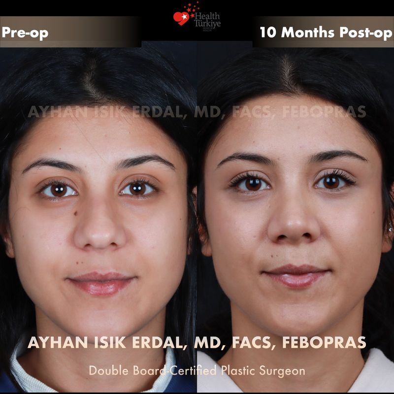 Male closed rhinoplasty before and after — frontal view, 4 months post-op