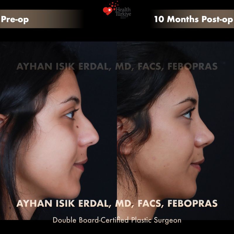 Male closed rhinoplasty before and after — profile view, 4 months post-op