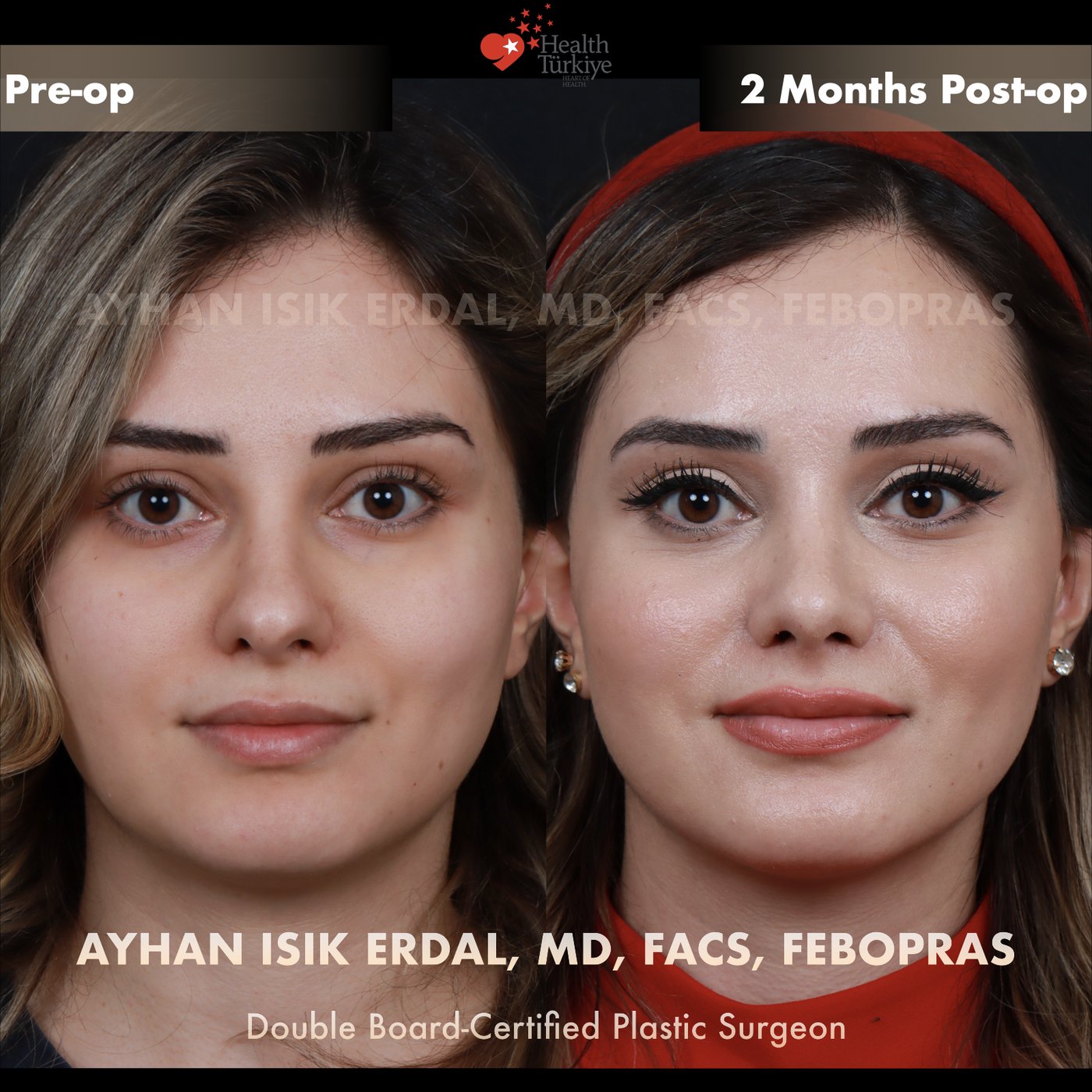 Revision rhinoplasty before and after — Patient #186, frontal view, 2 months post-op