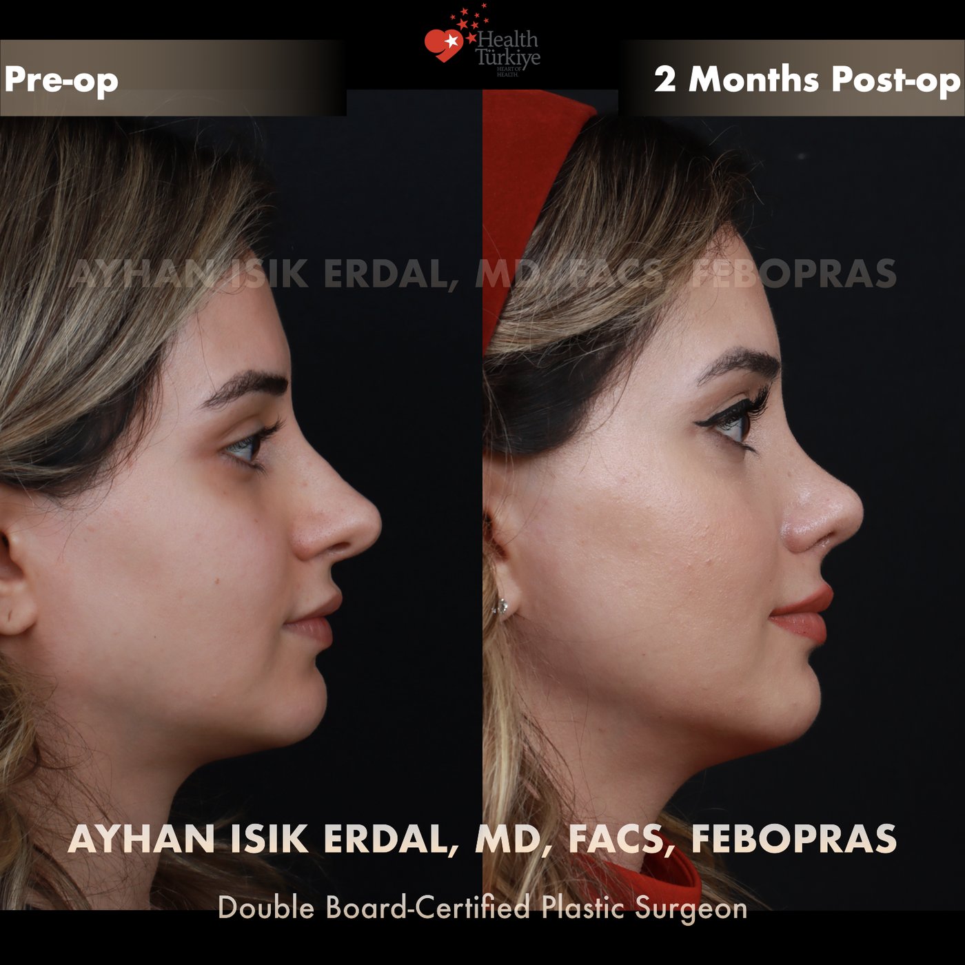 Revision rhinoplasty Patient #186 Profile (Right) view — pre-op vs 2 Months Post-op