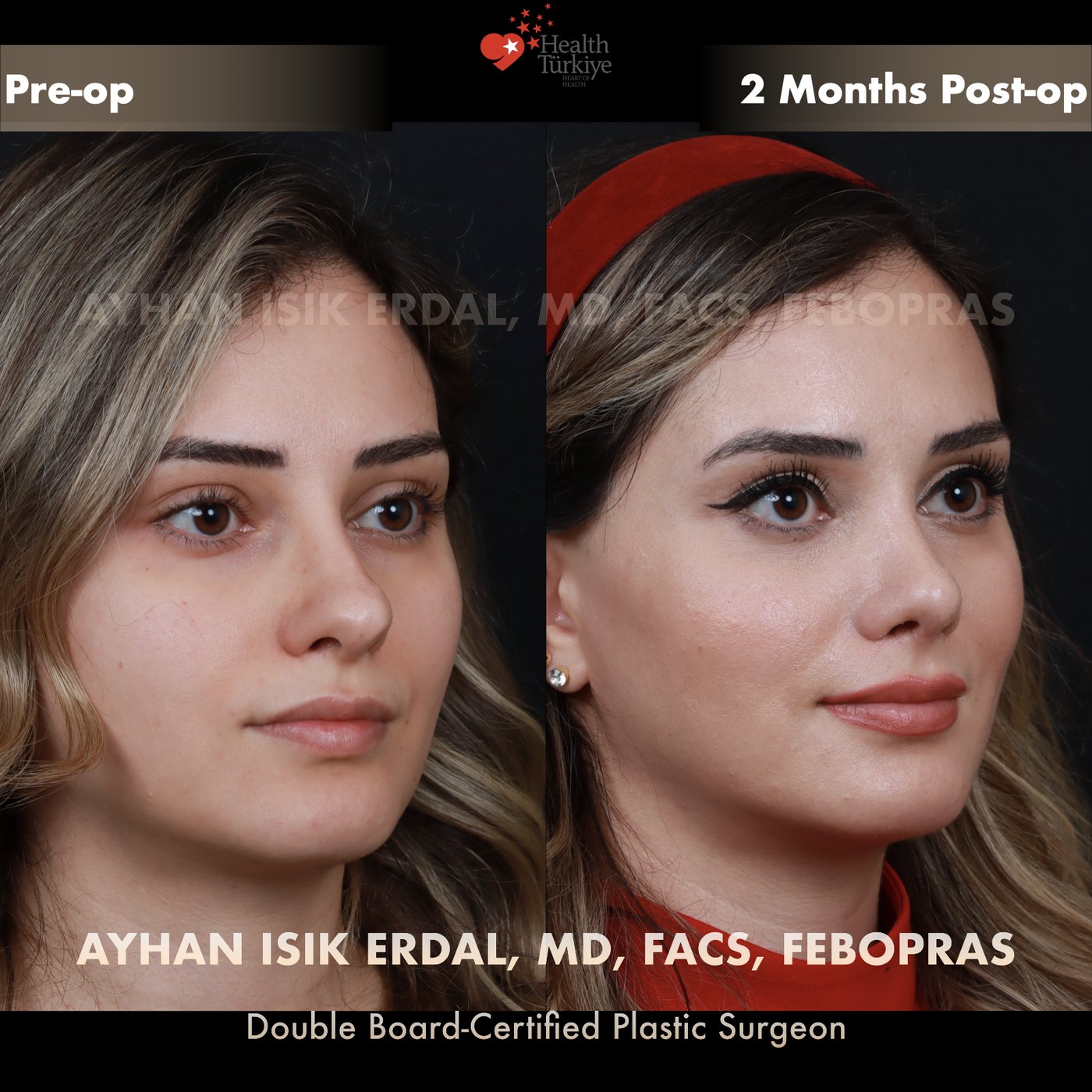 Revision rhinoplasty Patient #186 Oblique view — pre-op vs 2 Months Post-op
