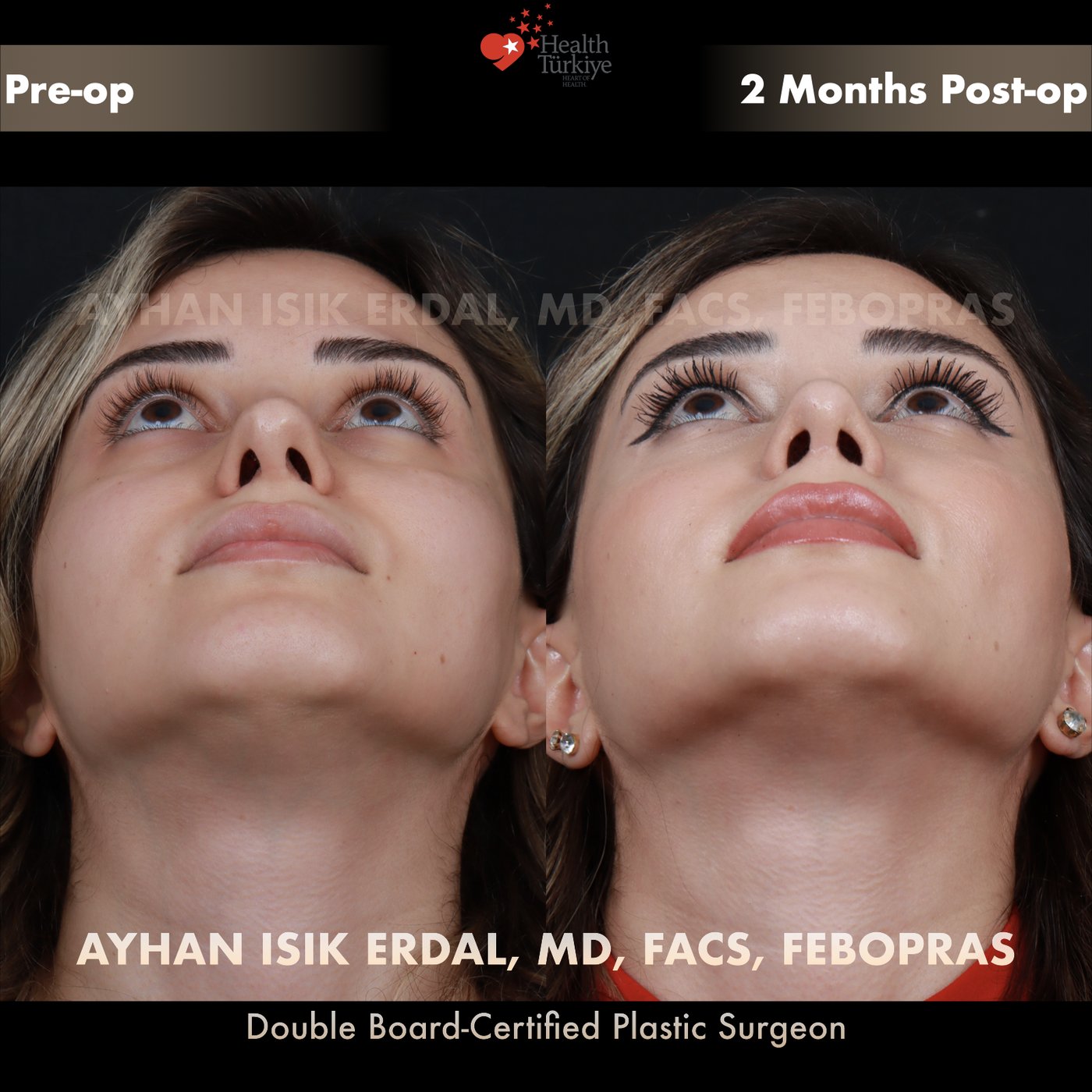 Revision rhinoplasty Patient #186 Profile (Left) view — pre-op vs 2 Months Post-op