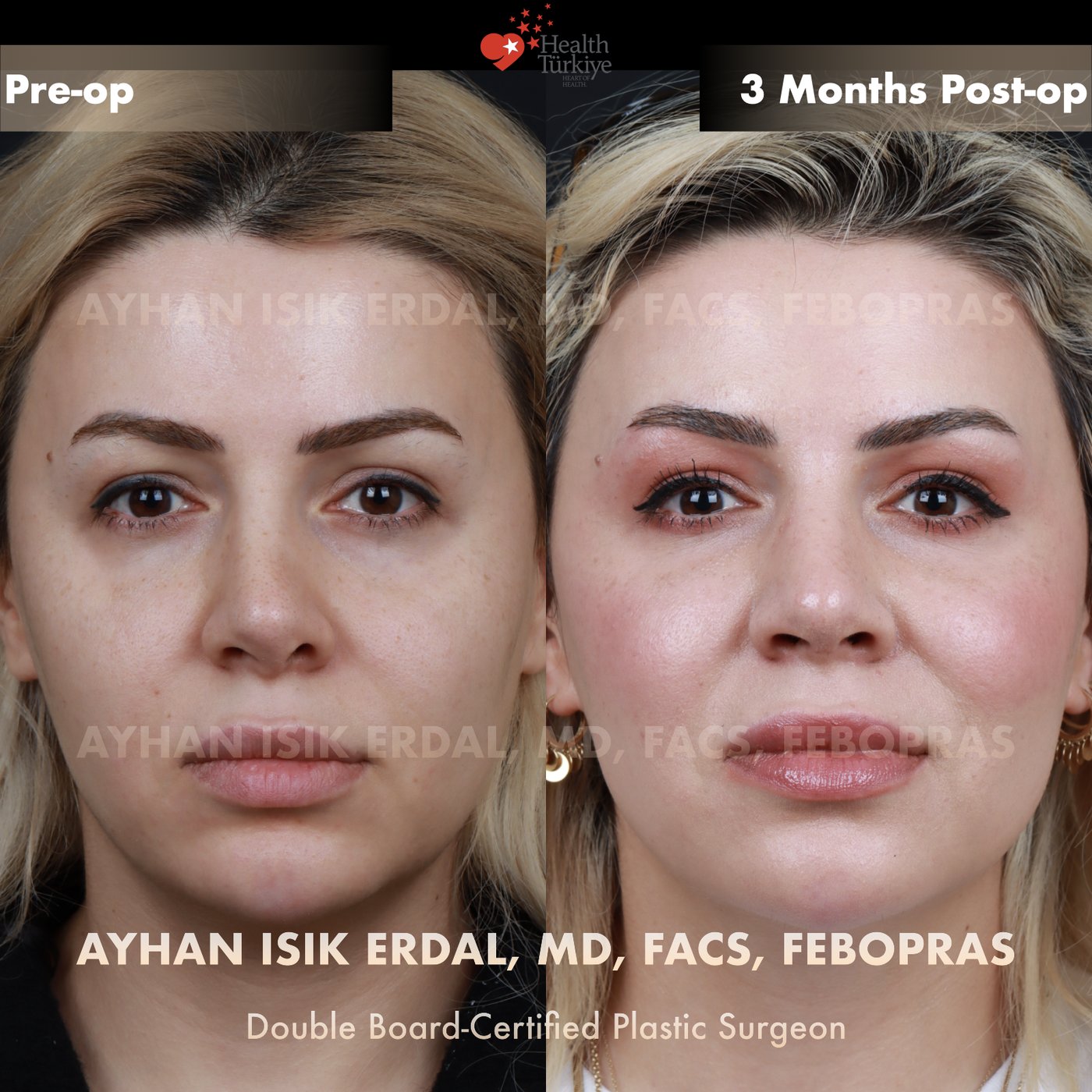 Revision rhinoplasty before and after — Patient #242, frontal view, 3 months post-op