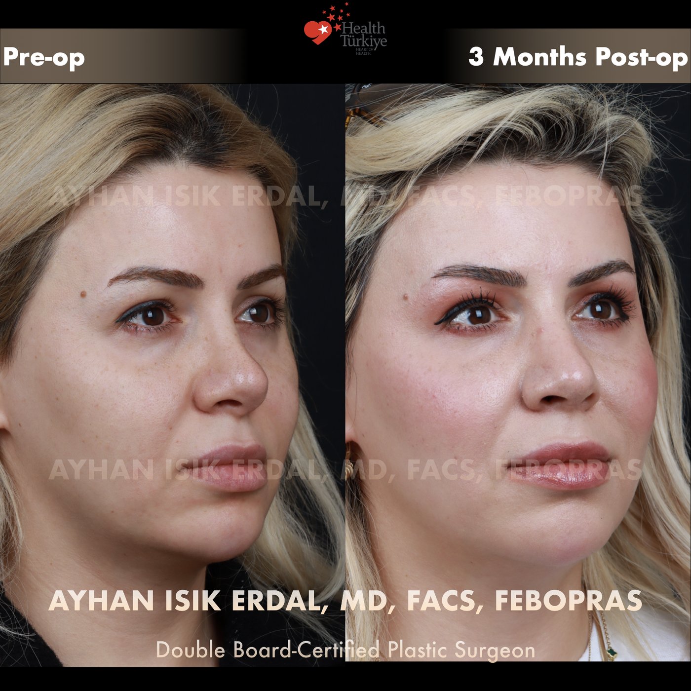 Revision rhinoplasty Patient #242 Oblique (Right) view — pre-op vs 3 Months Post-op
