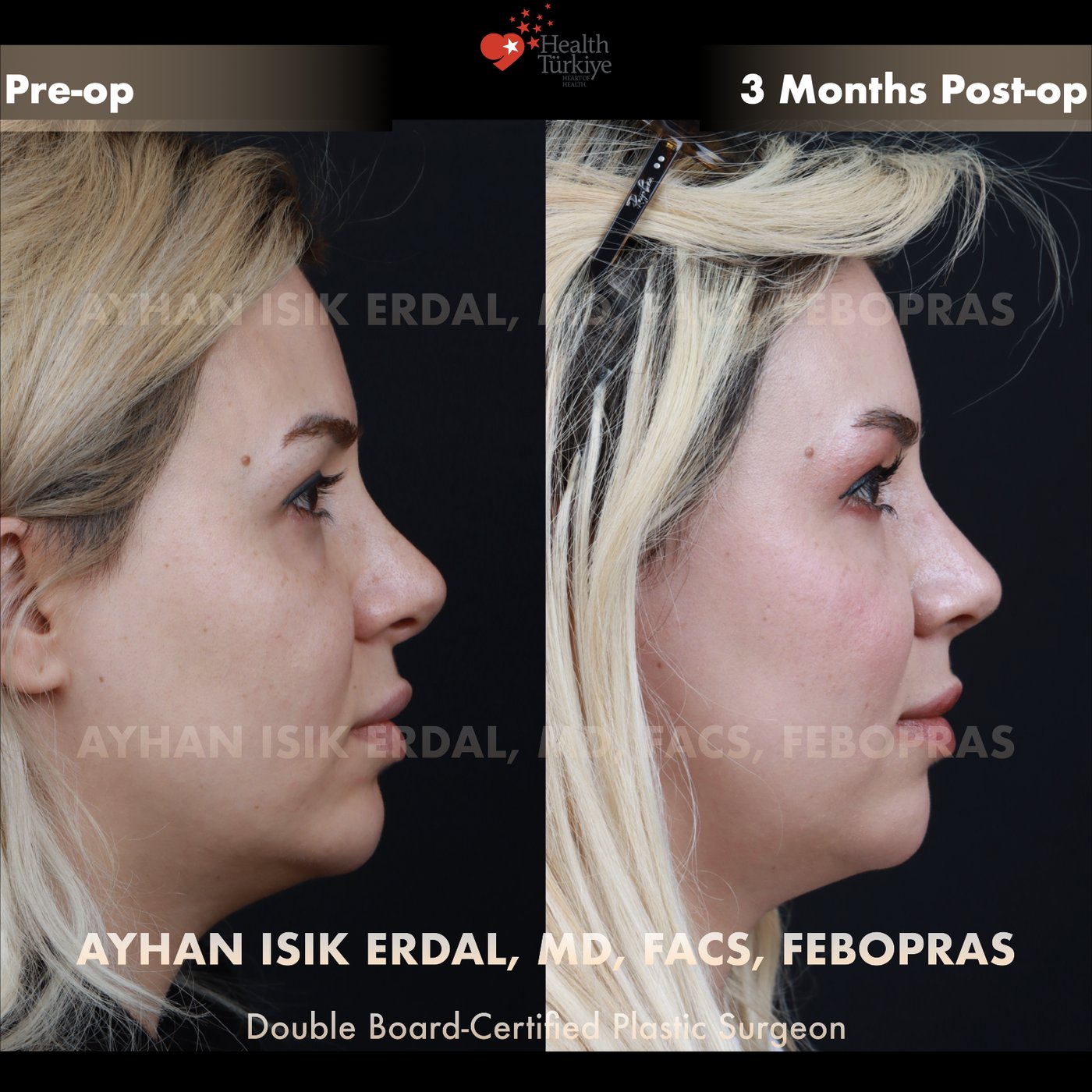 Revision rhinoplasty Patient #242 Profile (Right) view — pre-op vs 3 Months Post-op