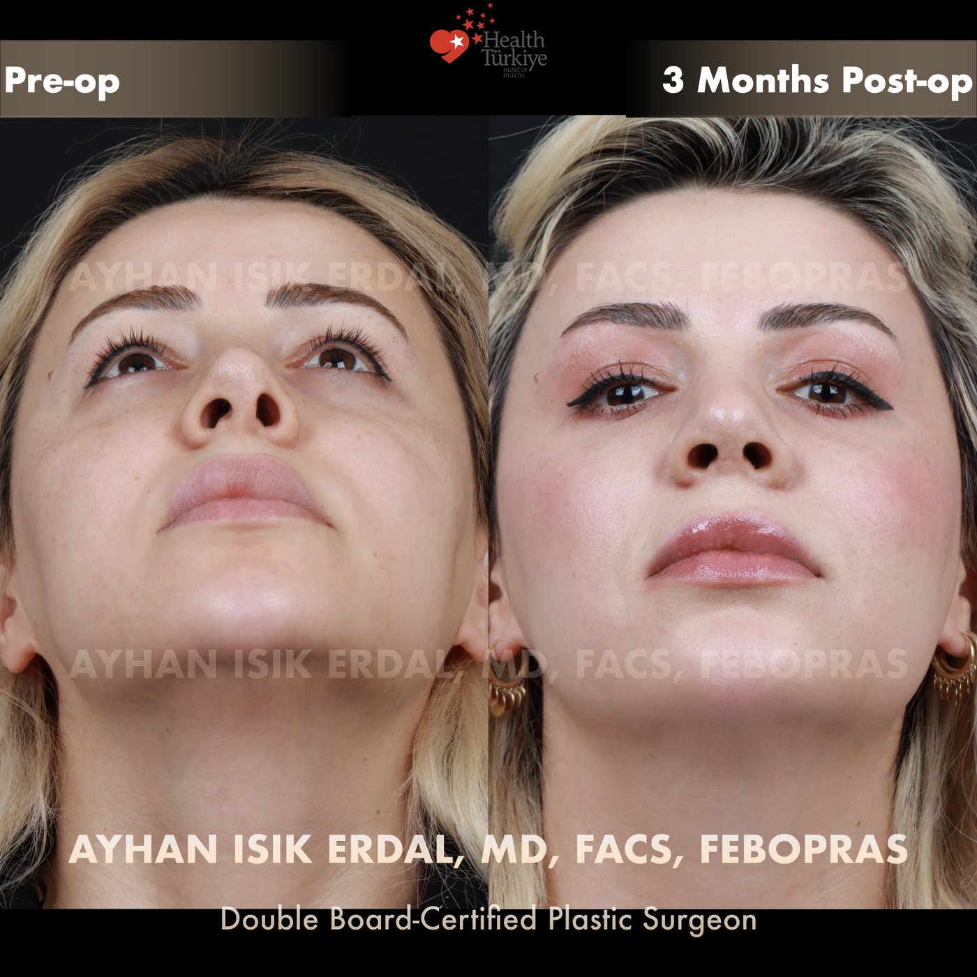 Revision rhinoplasty Patient #242 Profile (Left) view — pre-op vs 3 Months Post-op