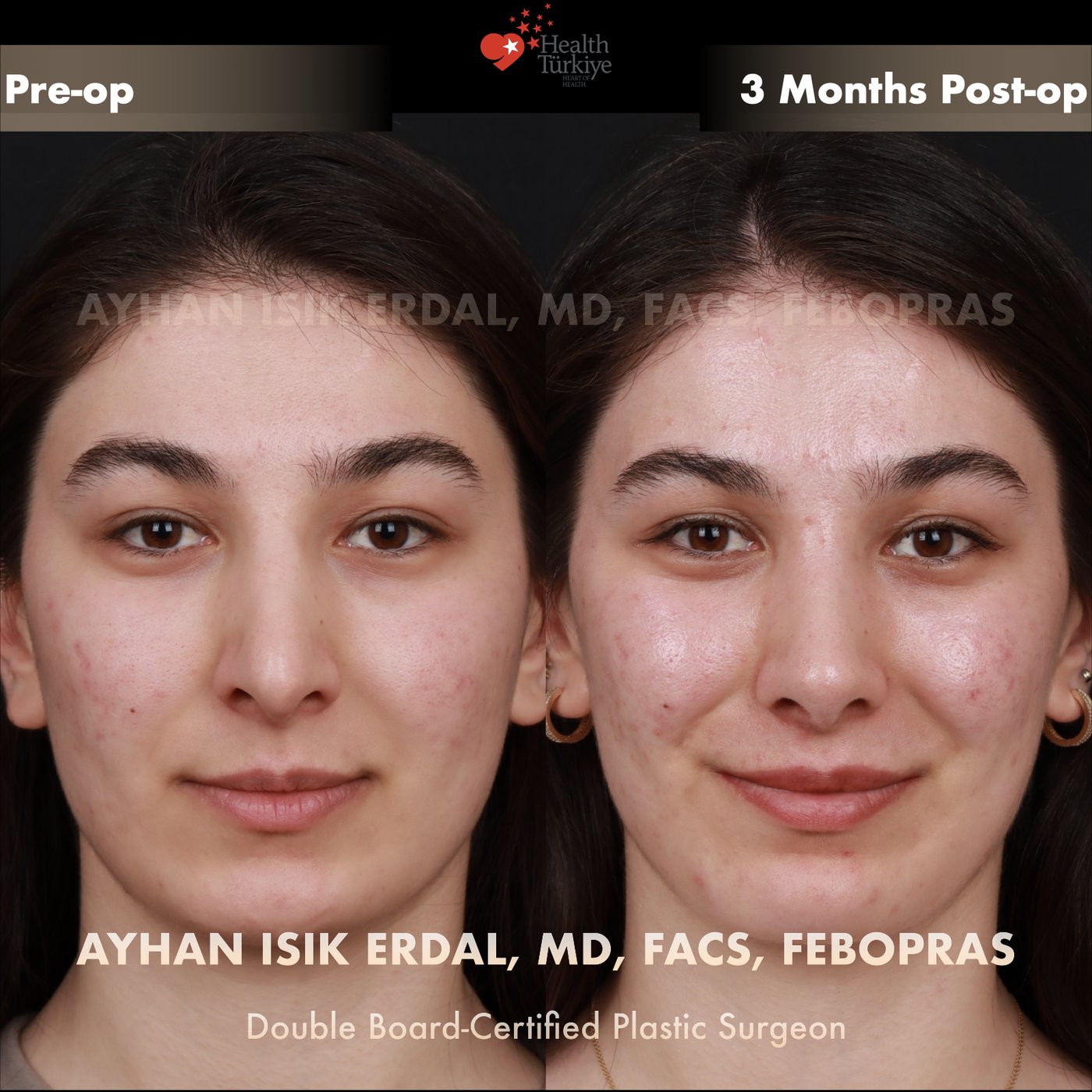 Revision rhinoplasty before and after — Patient #250, frontal view, 3 months post-op