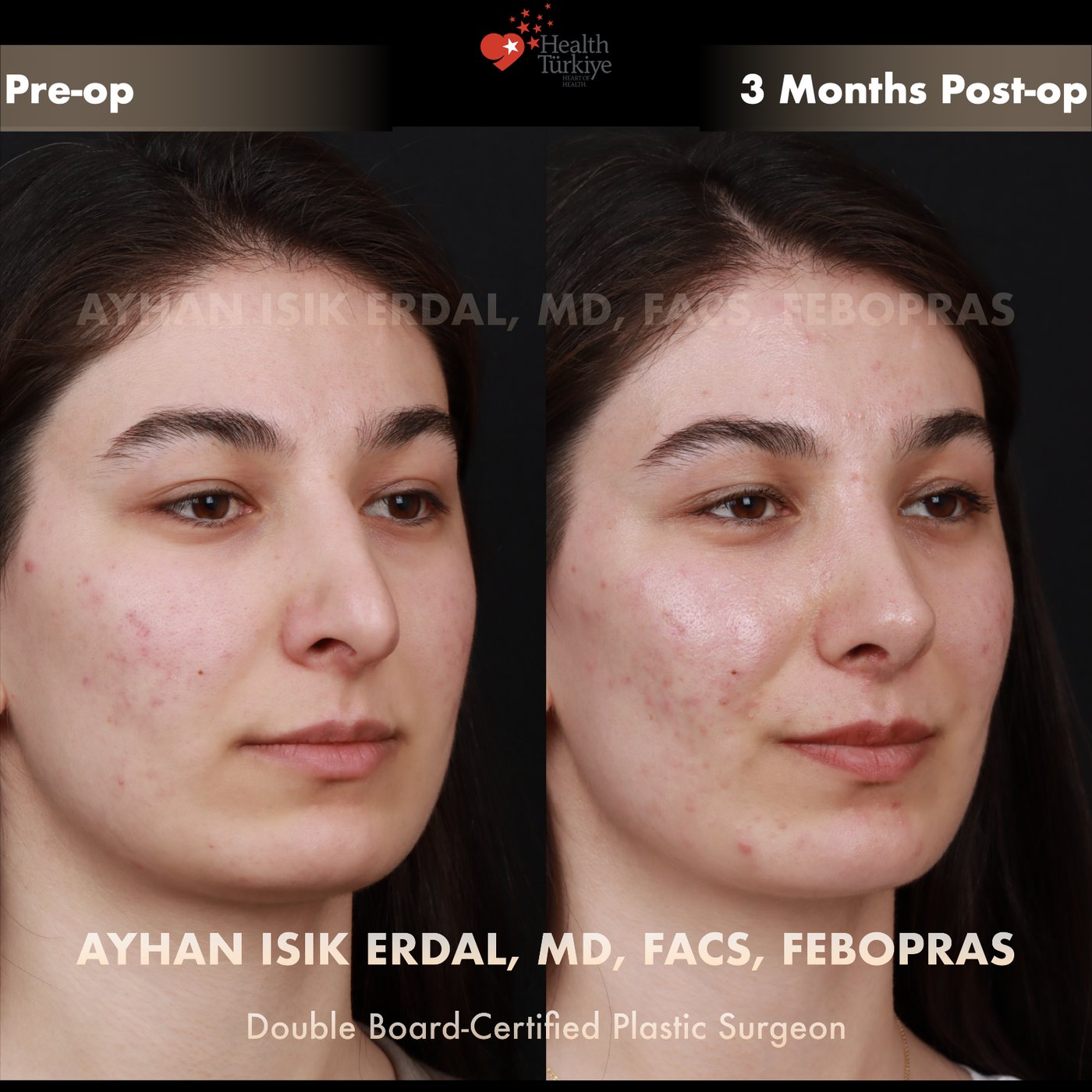 Revision rhinoplasty Patient #250 Oblique view — pre-op vs 3 Months Post-op