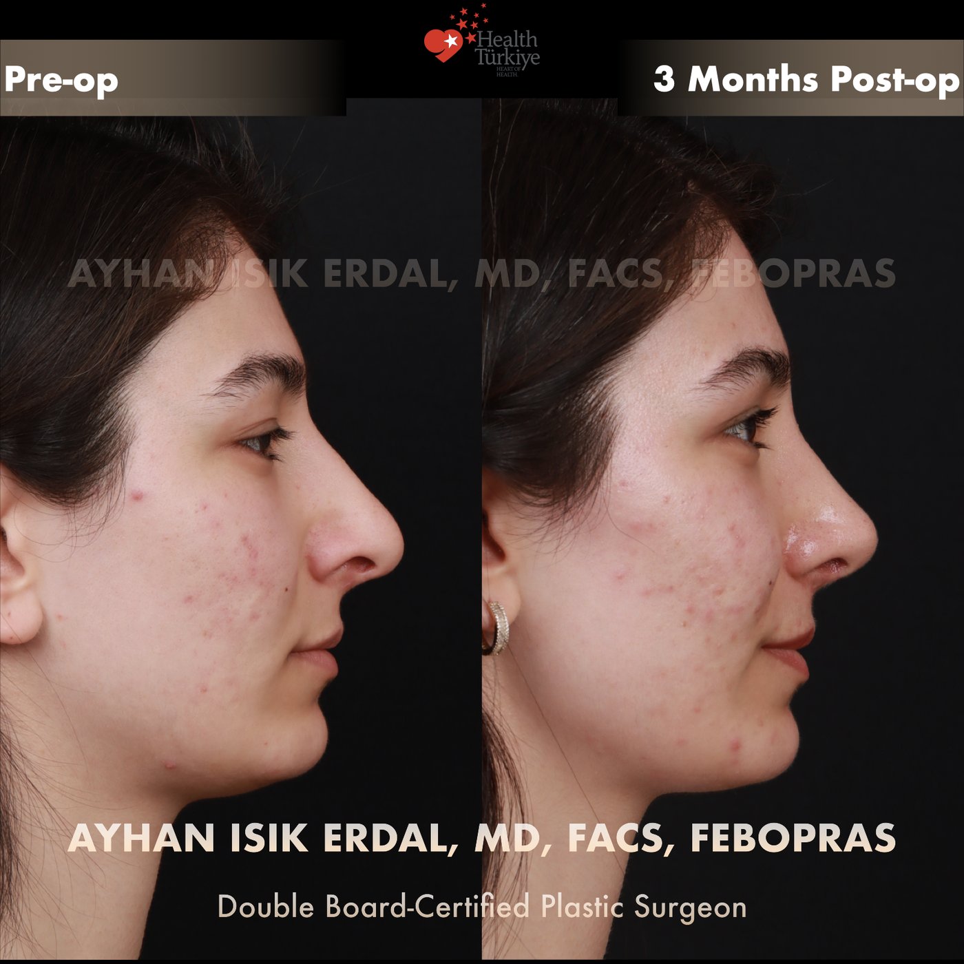 Revision rhinoplasty Patient #250 Profile view — pre-op vs 3 Months Post-op