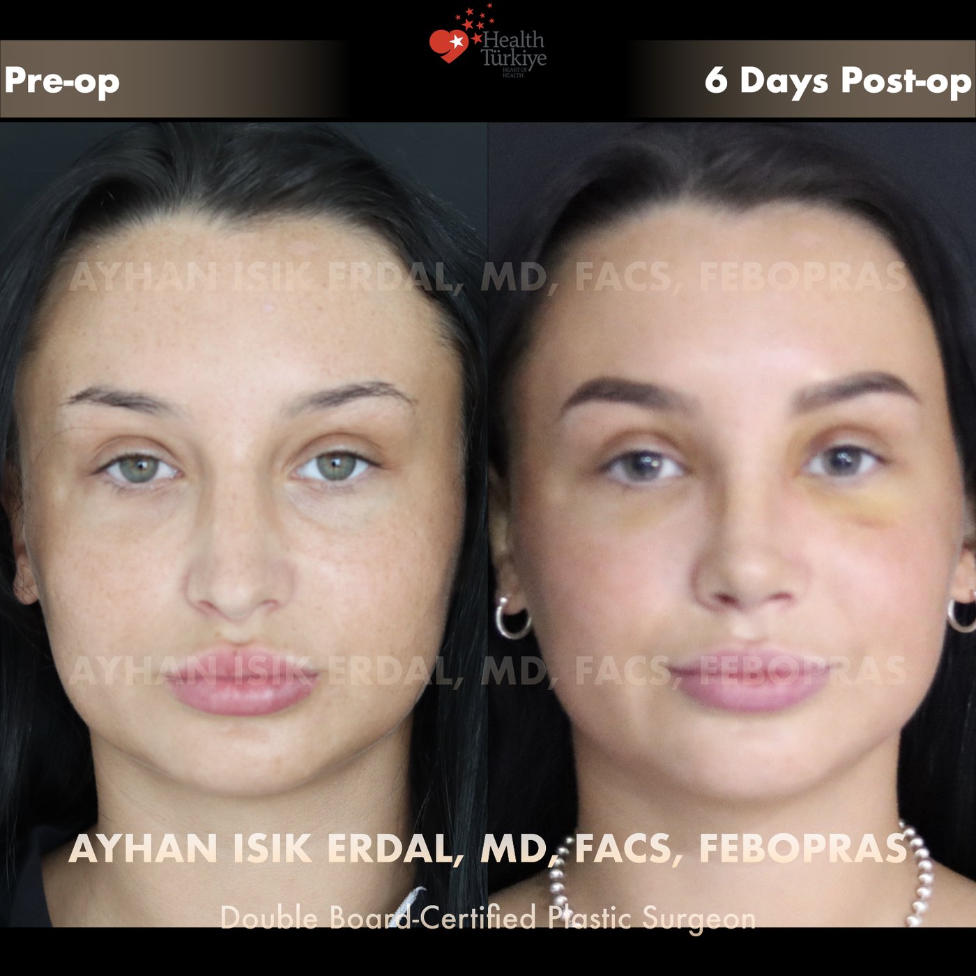 Revision rhinoplasty before and after — Patient #32, frontal view, 6 days post-op (early recovery)
