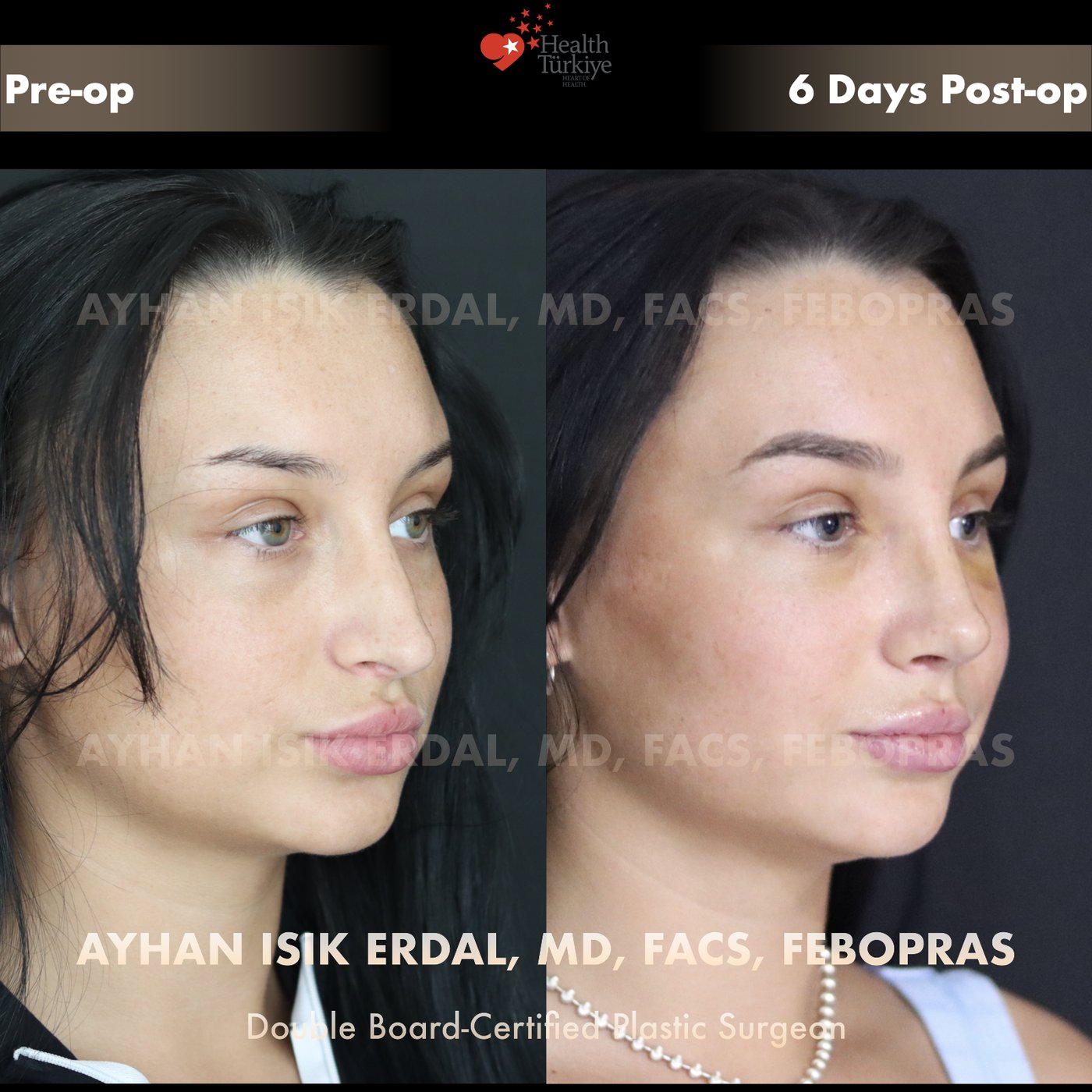 Revision rhinoplasty Patient #32 Oblique view — pre-op vs 6 Days Post-op