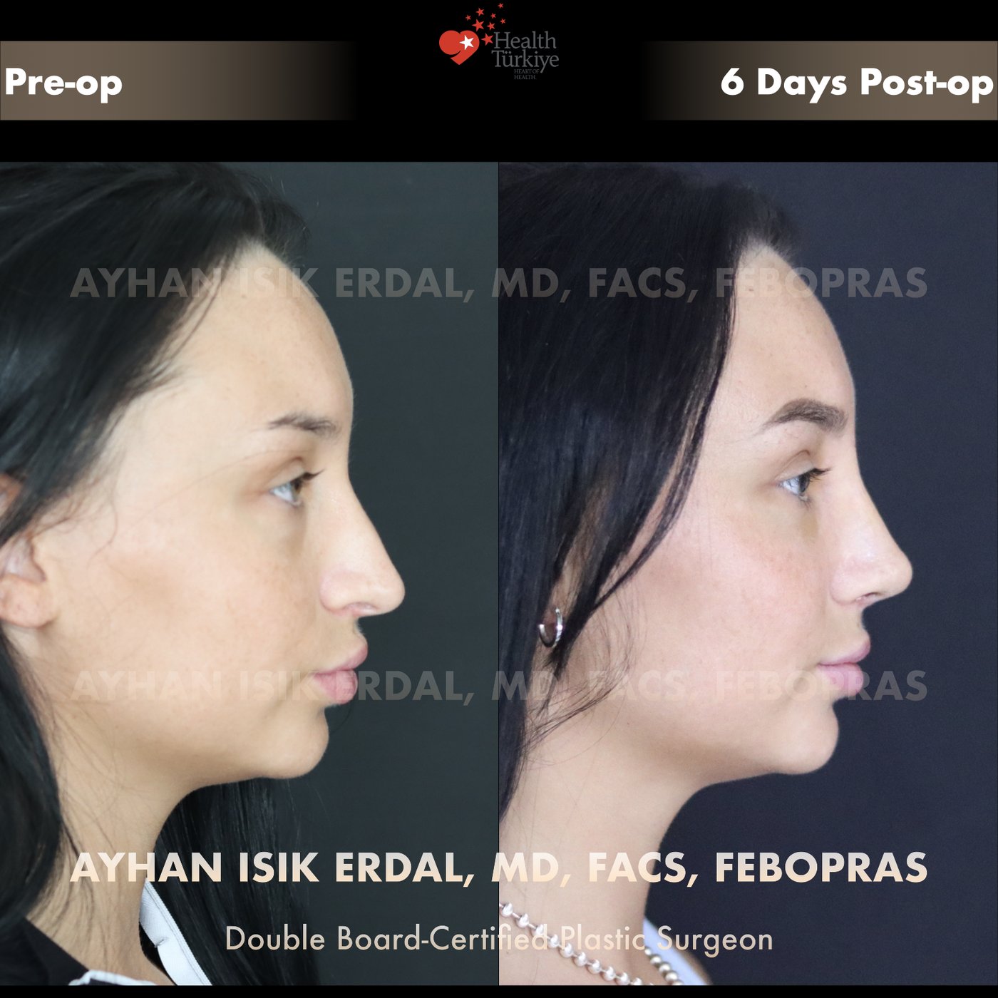 Revision rhinoplasty Patient #32 Profile view — pre-op vs 6 Days Post-op