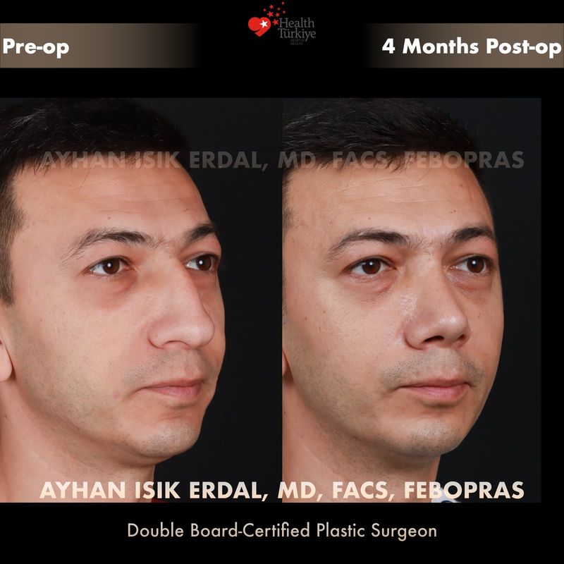 Nose job Istanbul before after — female patient oblique view, 10 months post-op