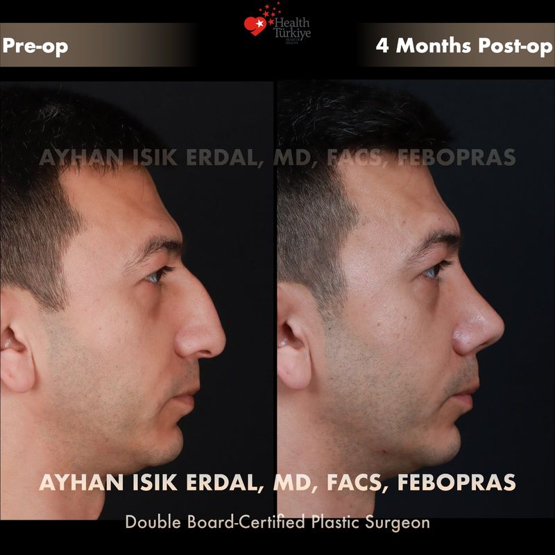 Nose job Istanbul before after — female patient profile view, 10 months post-op