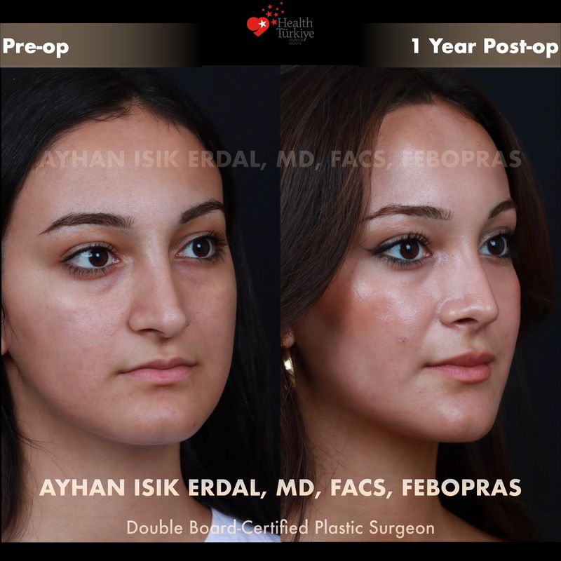 Closed rhinoplasty 1 year result — female patient oblique view