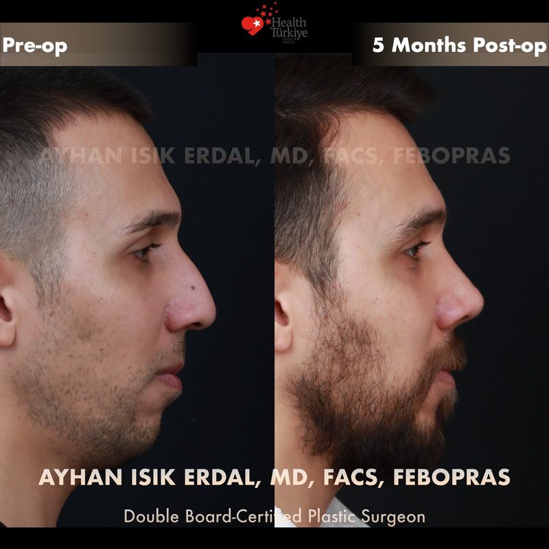 Male rhinoplasty Istanbul — oblique view before after, 5 months post-op