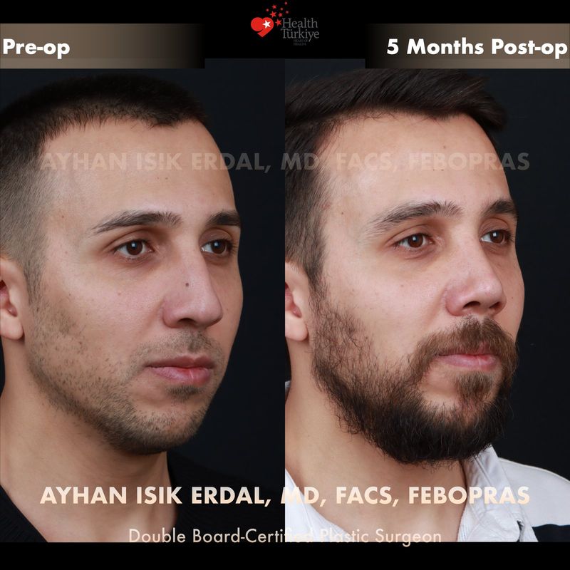 Male rhinoplasty Istanbul — profile view before after, 5 months post-op
