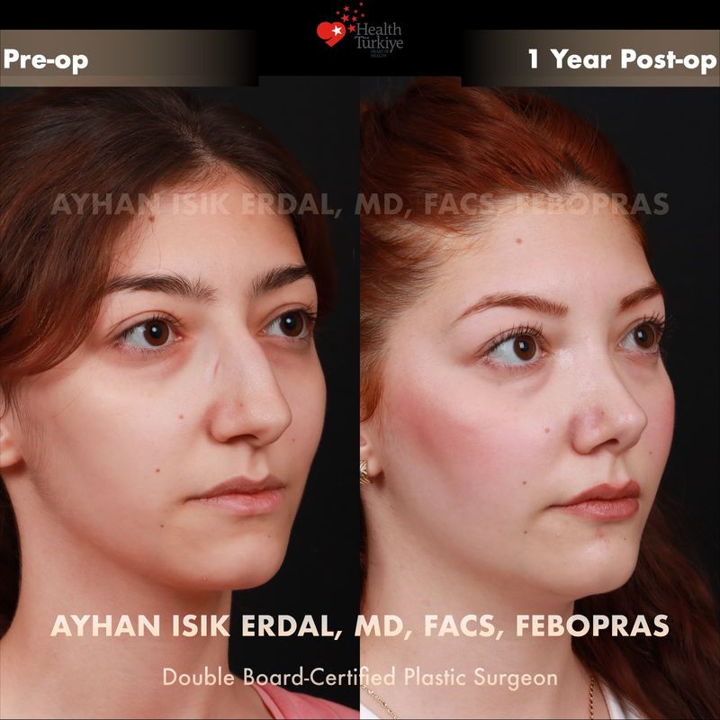 Rhinoplasty before after Istanbul — female patient oblique view, 1 year post-op